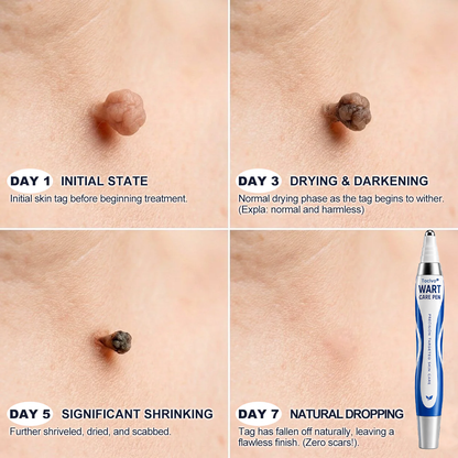 💧👨‍⚕️ Toclvo® Fast-Acting Wart Remover Care Pen | Targets Warts, Skin Tags & Rough Bumps